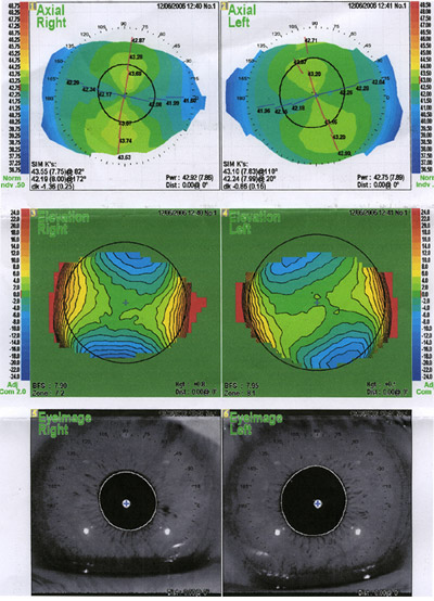 eye exam